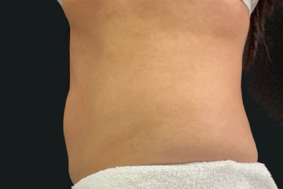 After Cryolipolysis After Cryolipolysis