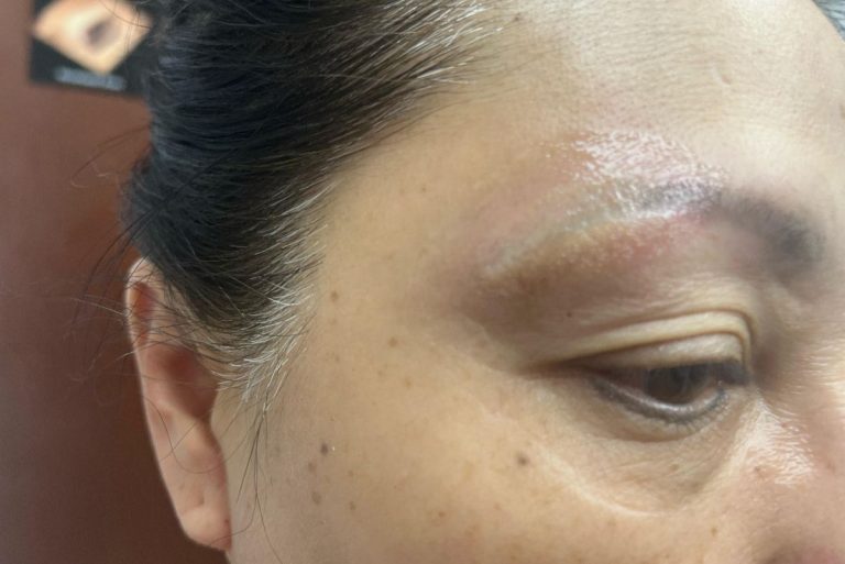 A Closeup Of Someone Who Has Gotten Laser Hair Removal.