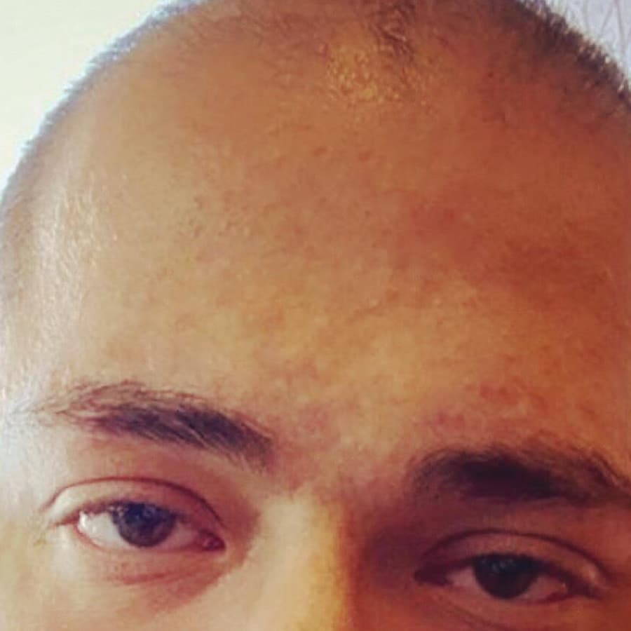 After Acne Corrective Facial After Acne Corrective Facial