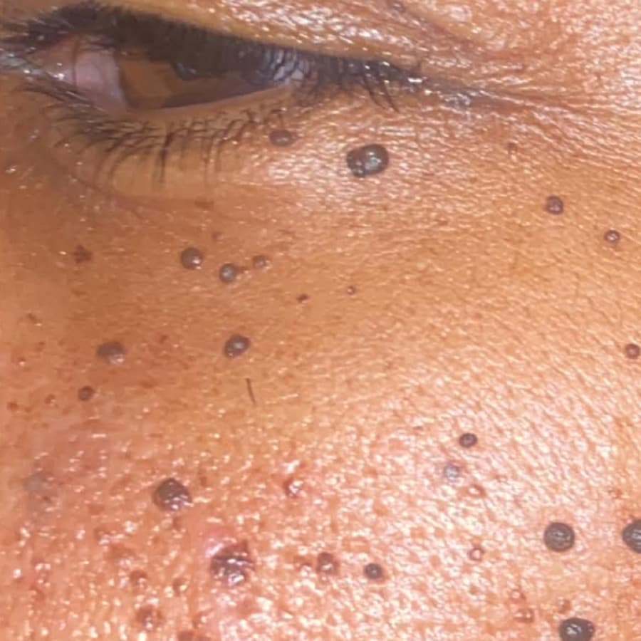 After Dark Spot Removal After Dark Spot Removal