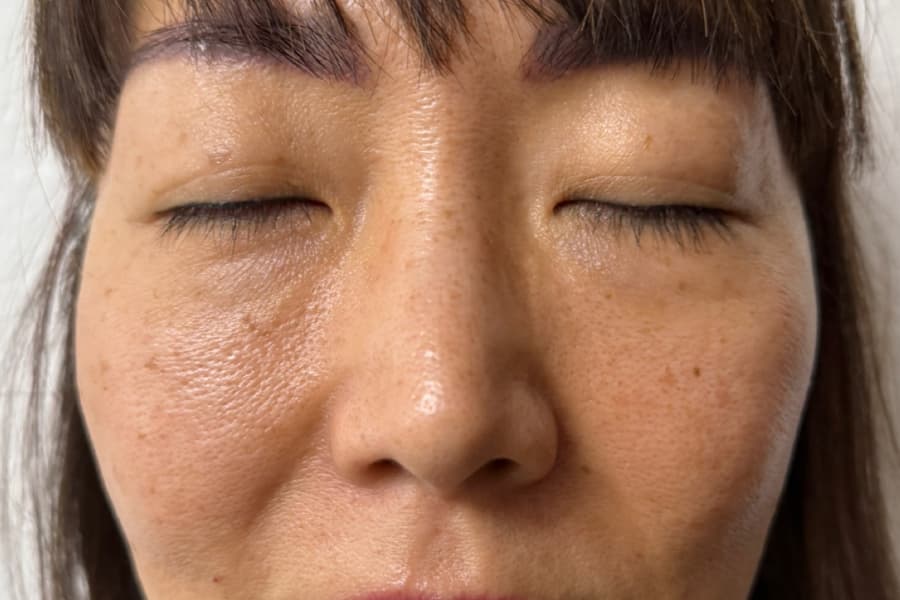 Before Facial Lymphatic Drainage